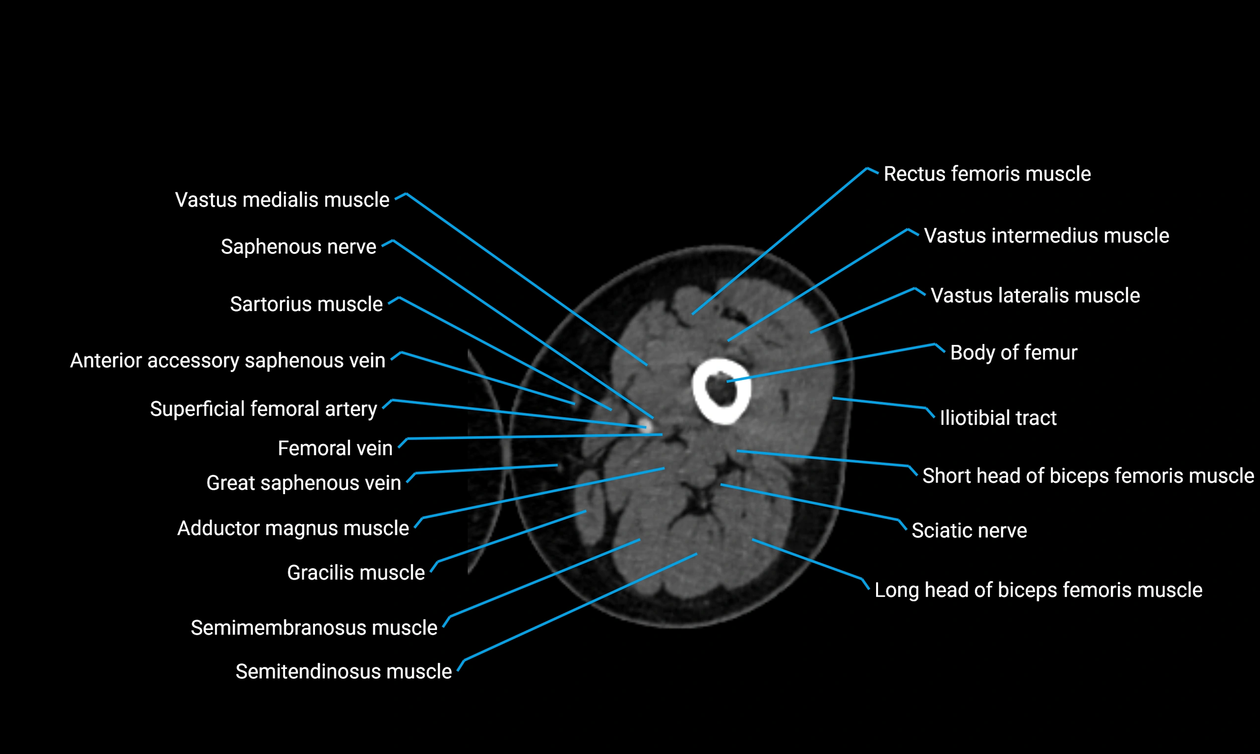 CT lower limb axial cross sectional anatomy labelled image 55 (2).webp
